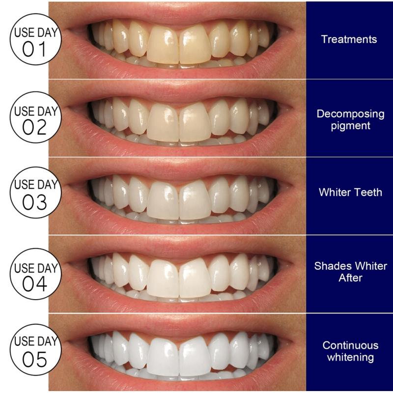 Teeth Whitening Strips for Teeth Sensitive
